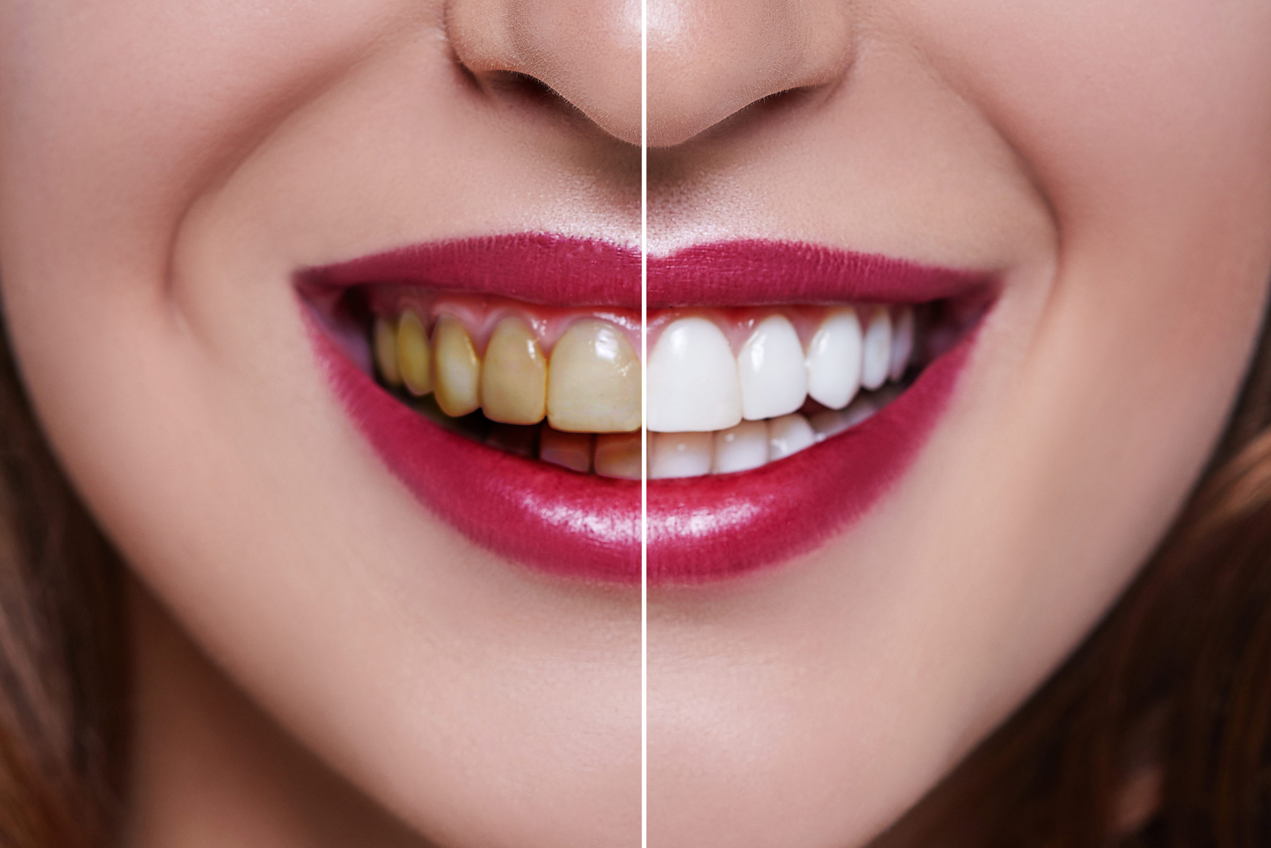 Dental Veneers - Tips to Get The Perfect Veneers